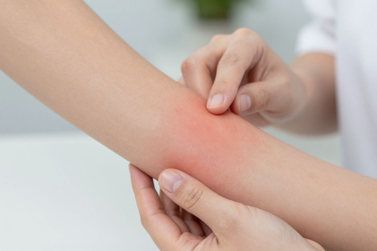 A Botox leggyakoribb mellékhatásai a duzzanat és bőrpír.