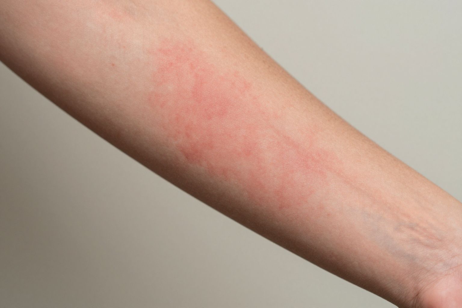 A sztatinok bőrkiütést és viszketést okozhatnak ritkán.