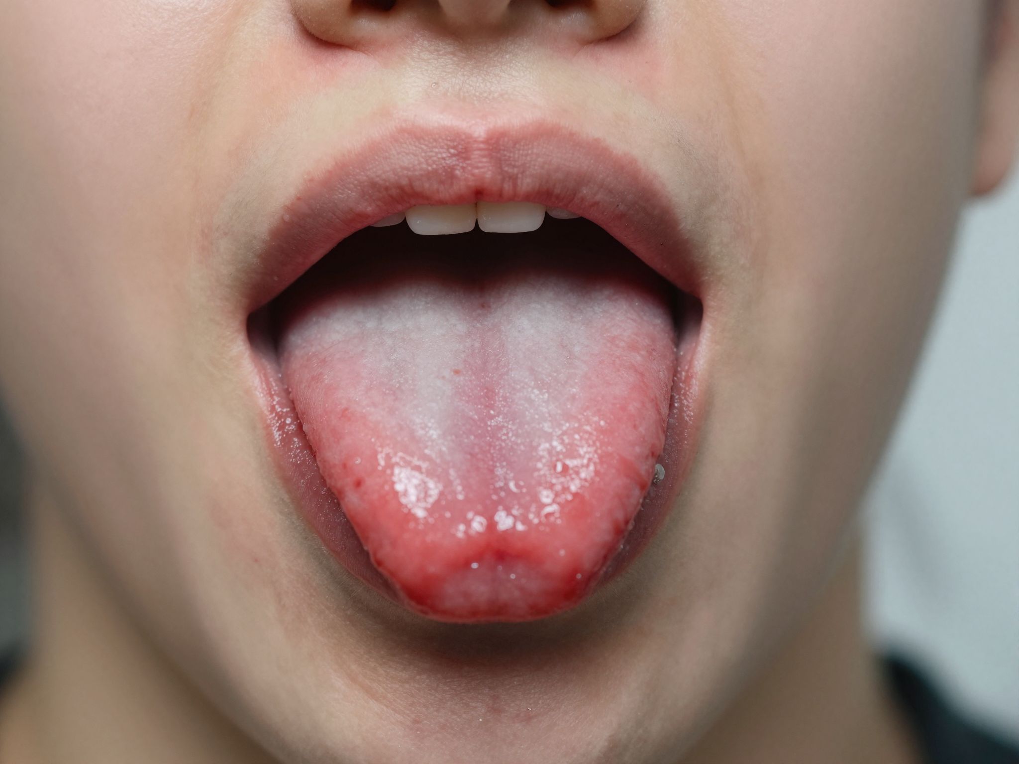 A fémérzékenység súlyos allergiás reakciókat válthat ki nyelvpiercingnél.